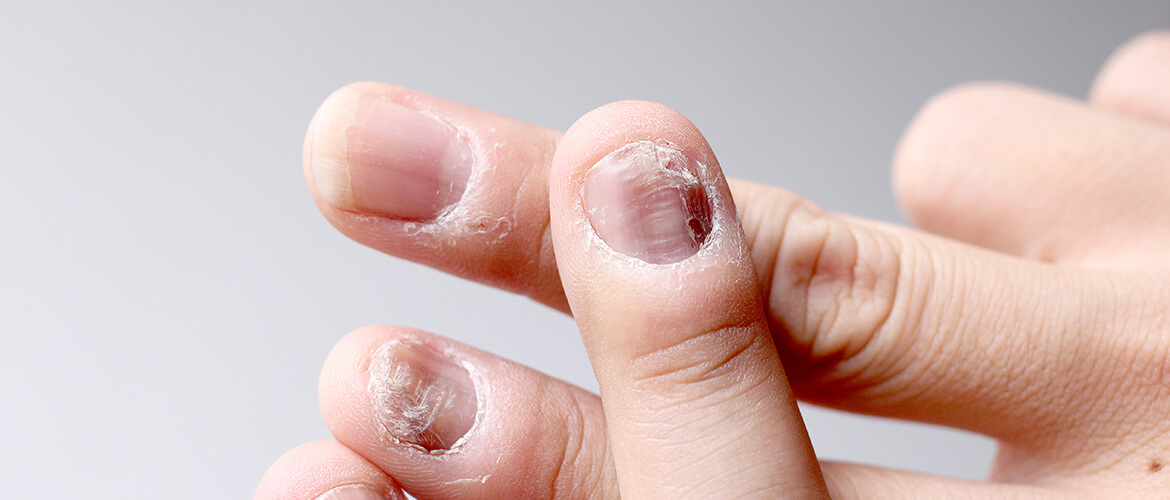 Onychomycosis (Nail Fungus) - Tran Plastic Surgery