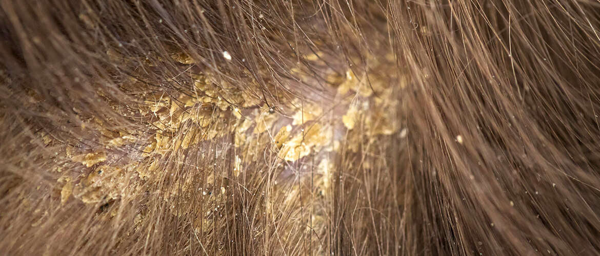 Yeast infection on the scalp  Malassezia scalp  Candida scalp  Neofollics