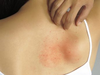 Prickly Heat: Causes, Symptoms, Prevention.