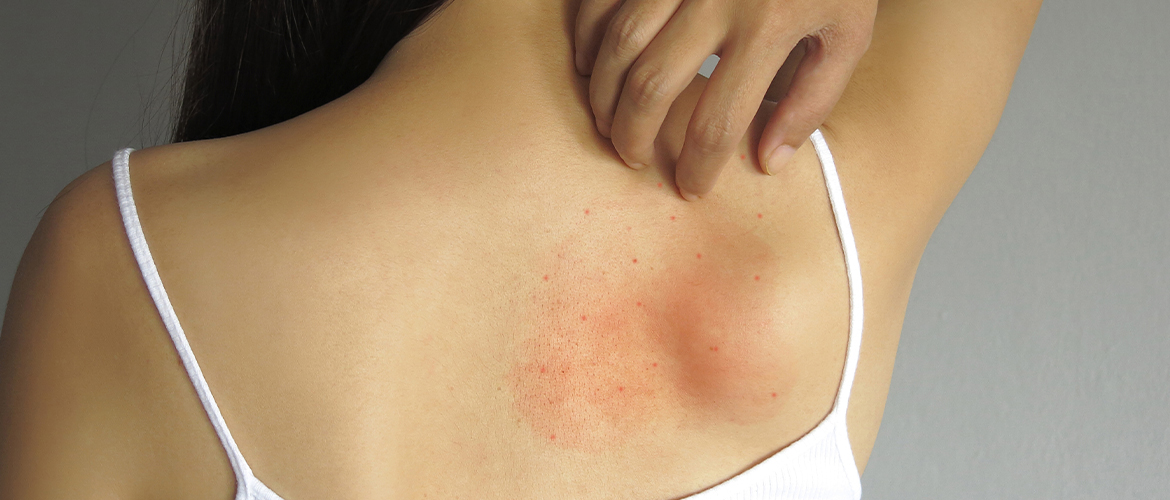 Prickly Heat: Causes, Symptoms, Prevention.