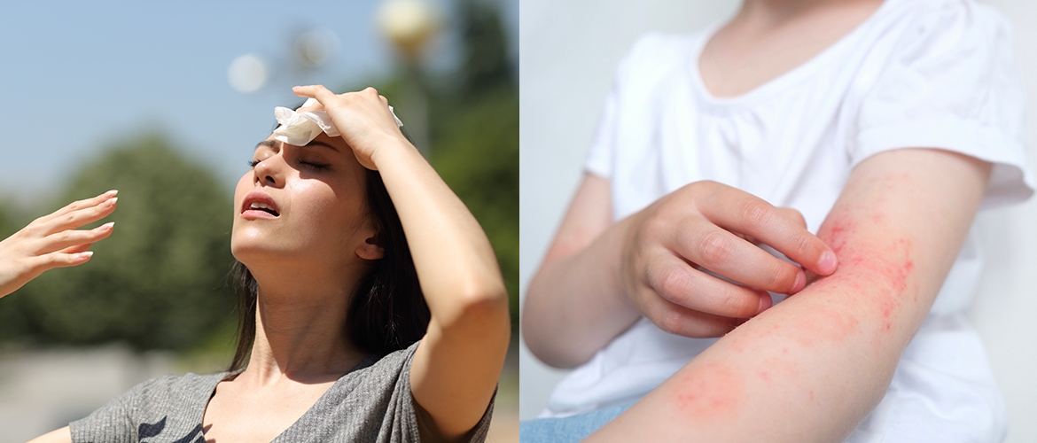 How Summer Heat Leads to Skin Infections: Prevention Tips | Clocip