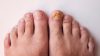 Fungal nail infection or onychomycosis are a type of fungal infection that affects the nails