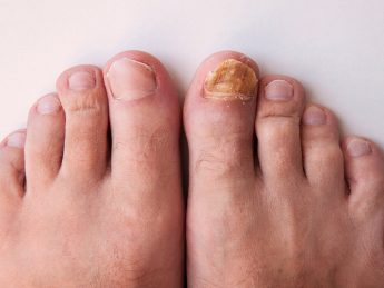 Fungal nail infection or onychomycosis are a type of fungal infection that affects the nails