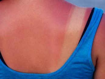 skin is exposed to the sun’s ultraviolet rays